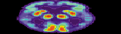 PET-skanneering Alzheimerihaige ajust.