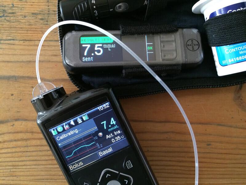 Insuliinipump täidab diabeedihaigele kõhunäärme funktsiooni.