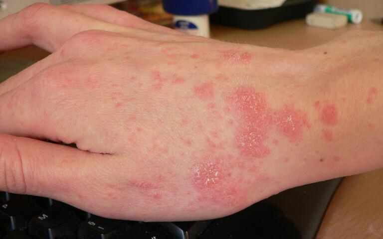 Scabies before treatment starts.